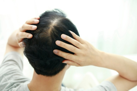 ‘빨리 좀 나왔으면’…제약사들, 탈모 치료제 개발 경쟁 치열